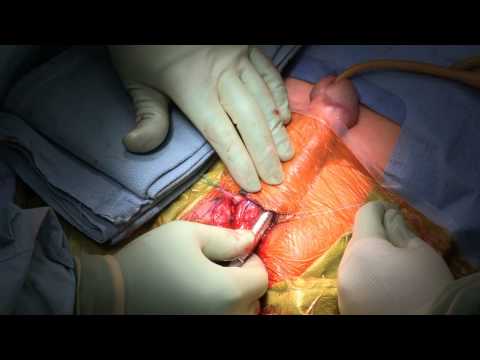 Retractor-less approach to IPP placement