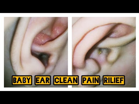 how to Baby Ear Cleaning Pain Rilief solution | Urdu in Hindi